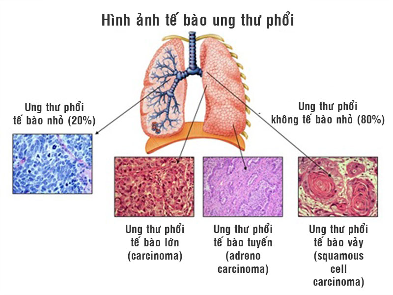 Triệu chứng và chẩn đoán ung thư phổi