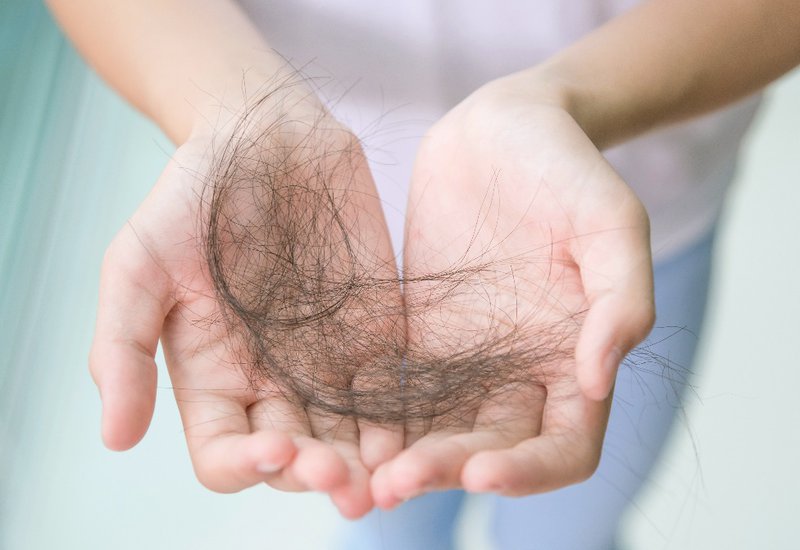 Bị rụng tóc nhiều ở nam là bệnh gì