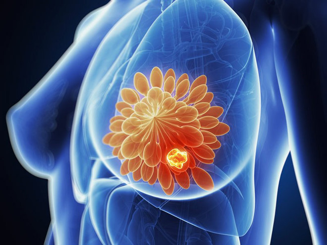 Ung thư vú ngày càng có dấu hiệu trẻ hóa