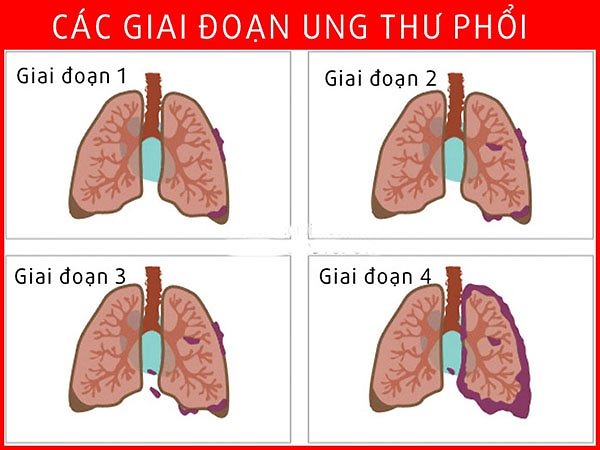 HÓA TRỊ LÀ MỘT TRONG NHỮNG LỰA CHỌN QUAN TRỌNG CHO UNG THƯ PHỔI GIAI ĐOẠN 3