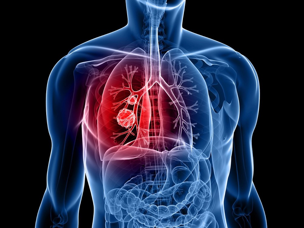 Có cách nào để phát hiện ung thư phổi giai đoạn 4 sớm không?
