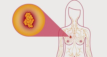 Tầm soát ung thư vú được thực hiện như thế nào