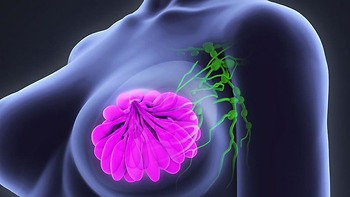 Các giai đoạn phát triển của ung thư vú mà phụ nữ nhất định phải nắm rõ