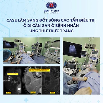 ĐỐT SÓNG CAO TẦN (RFA) ĐIỀU TRỊ Ổ DI CĂN GAN Ở NGƯỜI BỆNH UNG THƯ TRỰC TRÀNG