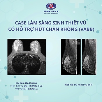 SINH THIẾT VÚ CÓ HỖ TRỢ HÚT CHÂN KHÔNG (VABB): TIẾP CẬN CHÍNH XÁC TỔN THƯƠNG TUYẾN VÚ NGHI NGỜ