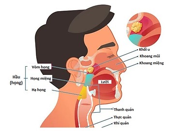 Ung thư vòm họng giai đoạn 2
