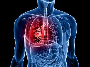 Hiểu đúng về ung thư phổi