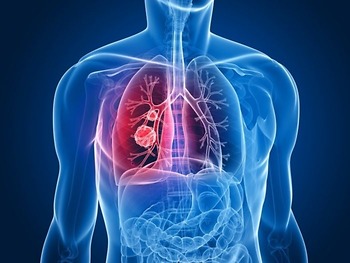 Nguyên nhân, dịch tễ, sàng lọc và phát hiện sớm ung thư phổi